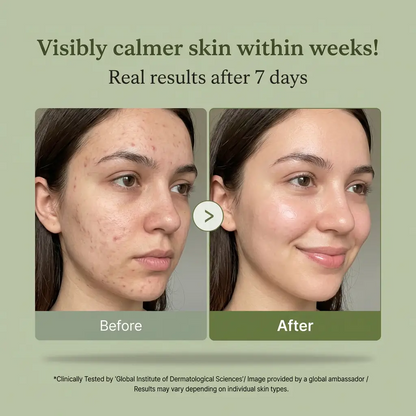 Ayoca Azelaic Acid 10%